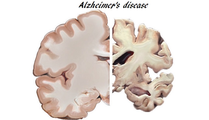 Alzheimer's disease